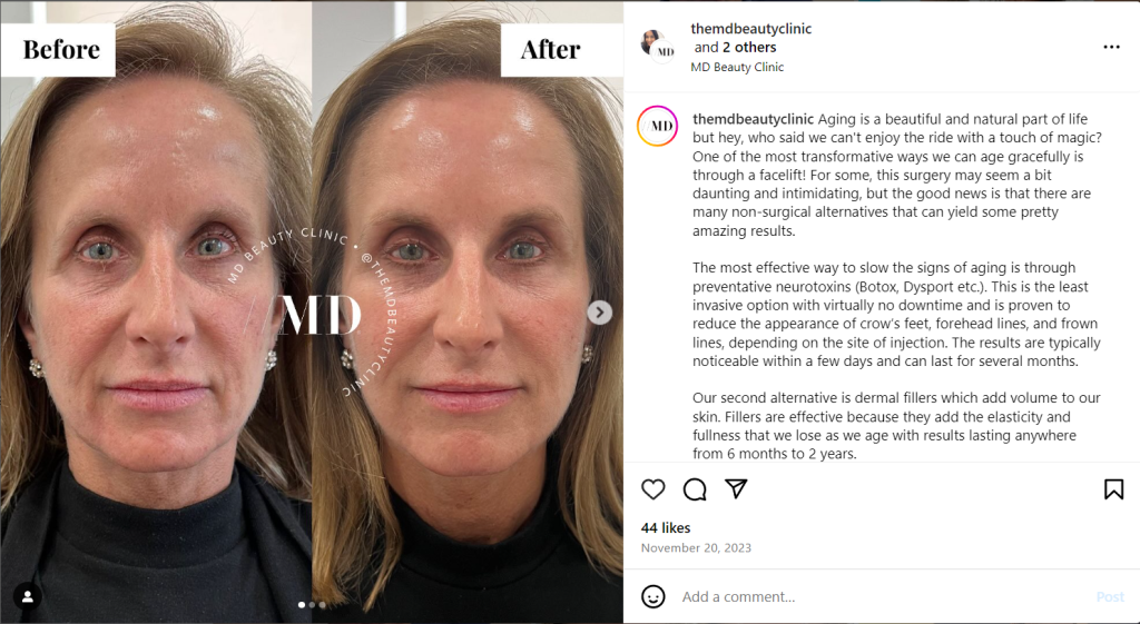 a mild example of before and after photos for social media of plastic surgeons