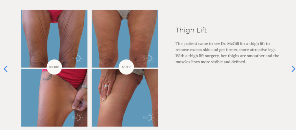 before and after photos can drive traffic and increase patient engagement with your plastic surgery content