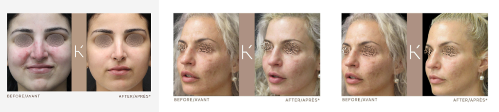 an example of before and after plastic surgery procedure photos gone wrong